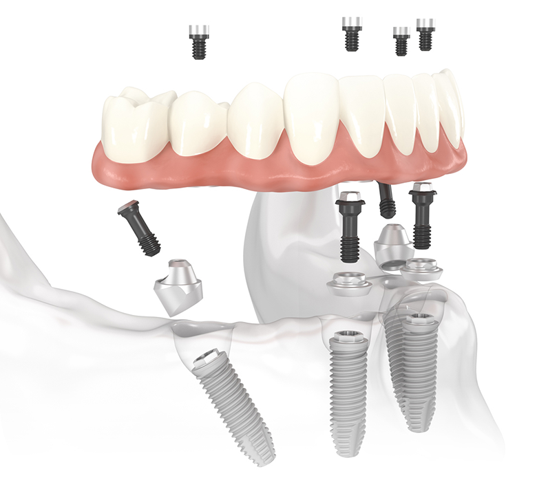 Implant Treatment